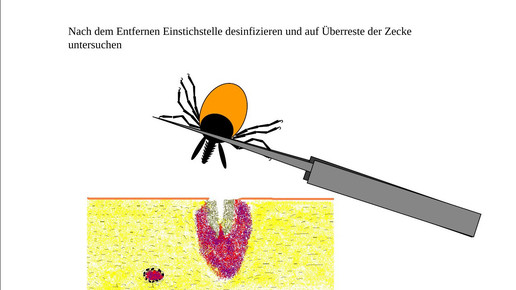 160614 zecke entfernung4 lglbayern