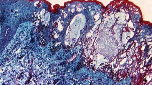 Varizella-Zoster-Virus cdc