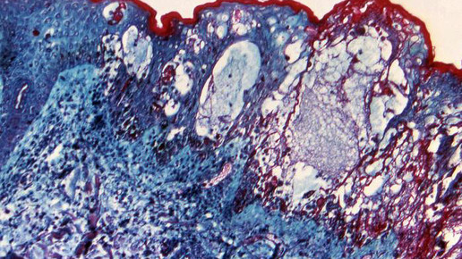 Varizella-Zoster-Virus cdc