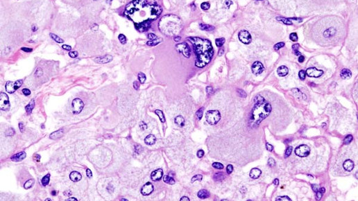 adrenal pheochromocytoma wikipedia cc by sa 3 0