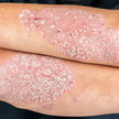 Keratoson comp.: Infectopharm bringt Fixkombi bei Psoriasis