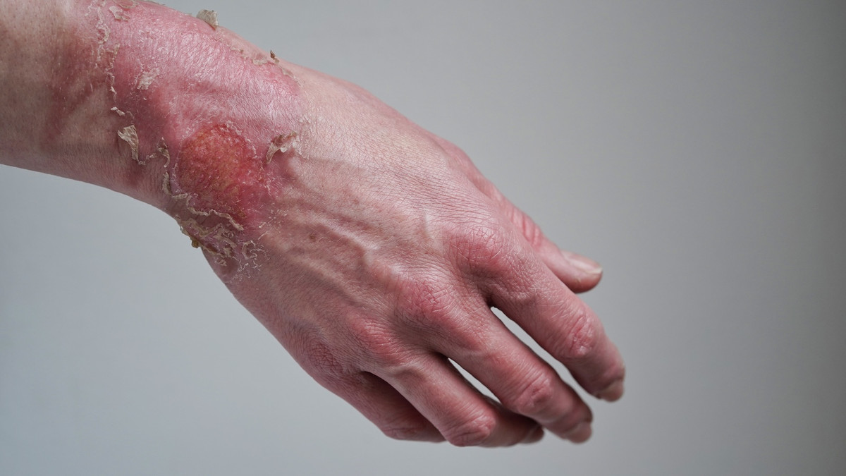 Brandwunden: Was hilft wirklich? | APOTHEKE ADHOC