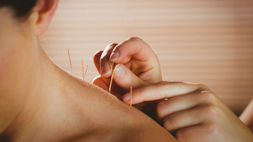 Akupunktur-Studie: Wunder-Nadeln gegen den Schmerz?