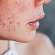 Akne: Haut-Schock im Erwachsenenalter