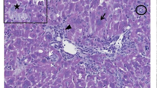 160621 kupferspeicherkrankheit helmholtz zentrum1