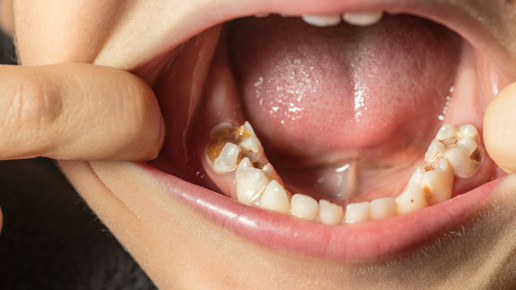 Mineralisationsstörung: Wenn Kinderzähne bröckeln