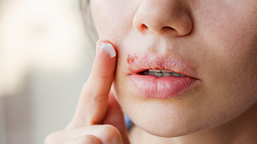 Herpes zoster: Höheres Risiko durch Depressionen