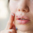 Aciclovir-Tablette ist rezeptfrei