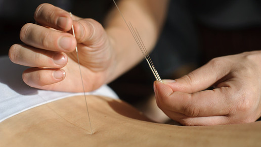 Bild 3 Entspannen durch Akupunktur