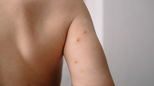 Ycanth: Erste Dell-Warzen-Therapie für Patienten ab 2 Jahren