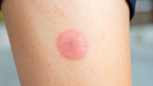 Zeckenbiss und Wanderröte: Antibiotikum, ja oder nein?