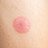 Zeckenbiss und Wanderröte: Antibiotikum, ja oder nein?