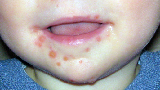 Hand-Fuß-Mund-Krankheit heilt meist von allein wieder ab