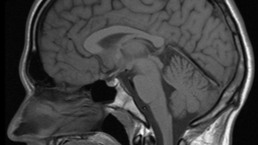 Aus für Gadopentetsäure