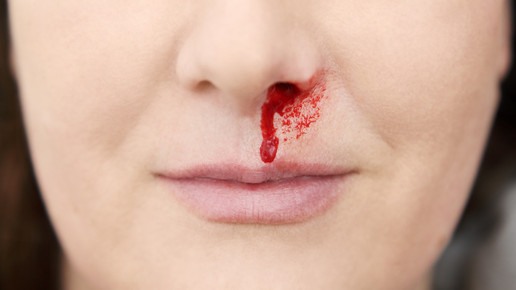 nasenbluten friedberg fotolia