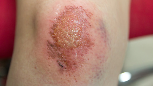 Infizierte Wunden: Silber gegen Keime