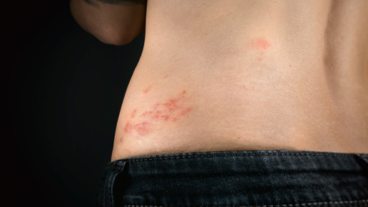 Gürtelrose-Impfung und Hautreaktion: Kein kausaler Zusammenhang