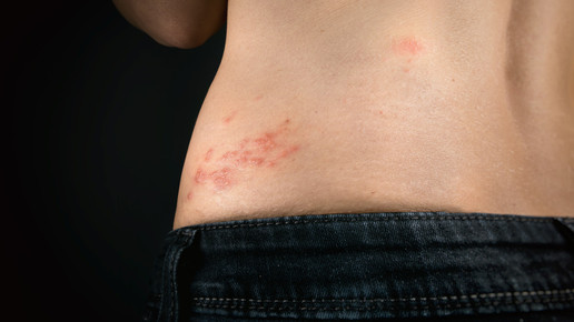 Covid-19: Risikofaktor für Herpes zoster