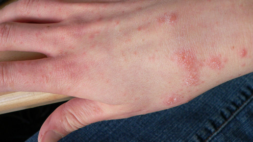 Hessen: Krätze auf dem Vormarsch