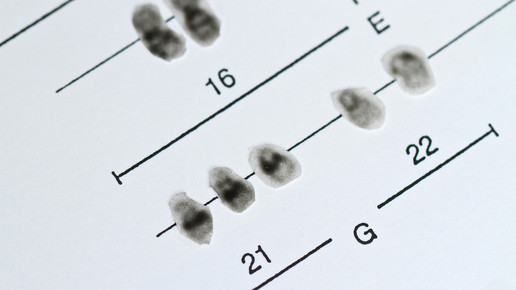 Alzheimer-Risiko bei Down-Syndrom