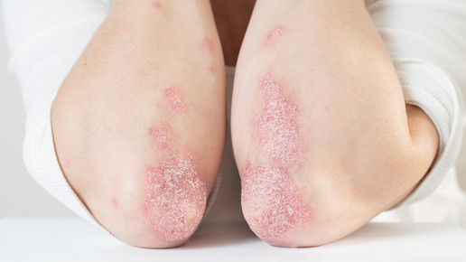 Foto: Psoriasis an den Ellbogen.
