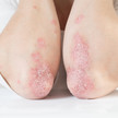 Foto: Psoriasis an den Ellbogen.