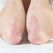 Psoriasis: Deucravacitinib als neue Therapie-Option Foto: Psoriasis an den Ellbogen.