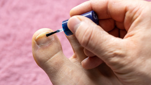 Foto: Eine Person mit mildem Nagelpilz am rechten Zeh trägt ein Präparat auf