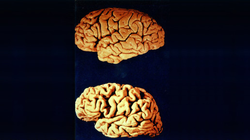 alzheimer gehirne profkonradmaurer