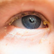 Covid-19: Arcturus führt zu Bindehautentzündung