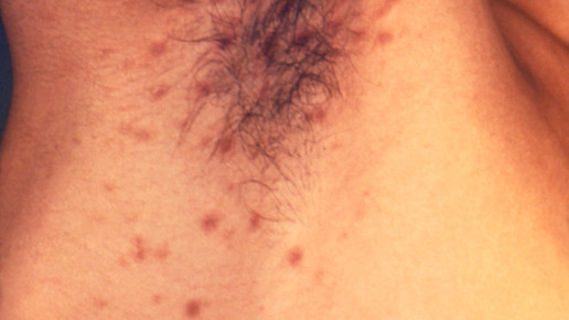 skabies CDC Susan Lindsley