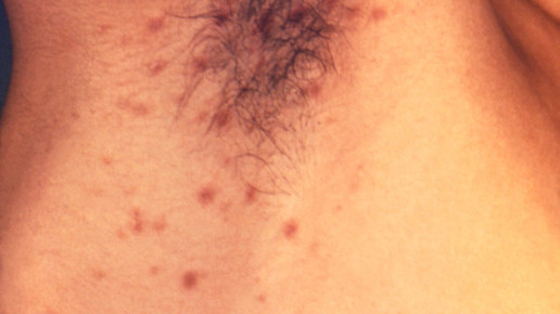 skabies CDC Susan Lindsley