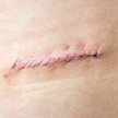 Narben nach der OP: Richtig gepflegt heilt besser