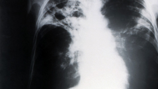 tuberkulose roentgen cdc