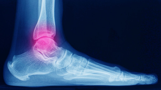 Röntgenbild eines Fußes inklusive pink markiertem Sprunggelenk von der Seite.