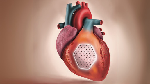 Herzinsuffizienz: „Herzpflaster“ erstmals am Menschen getestet