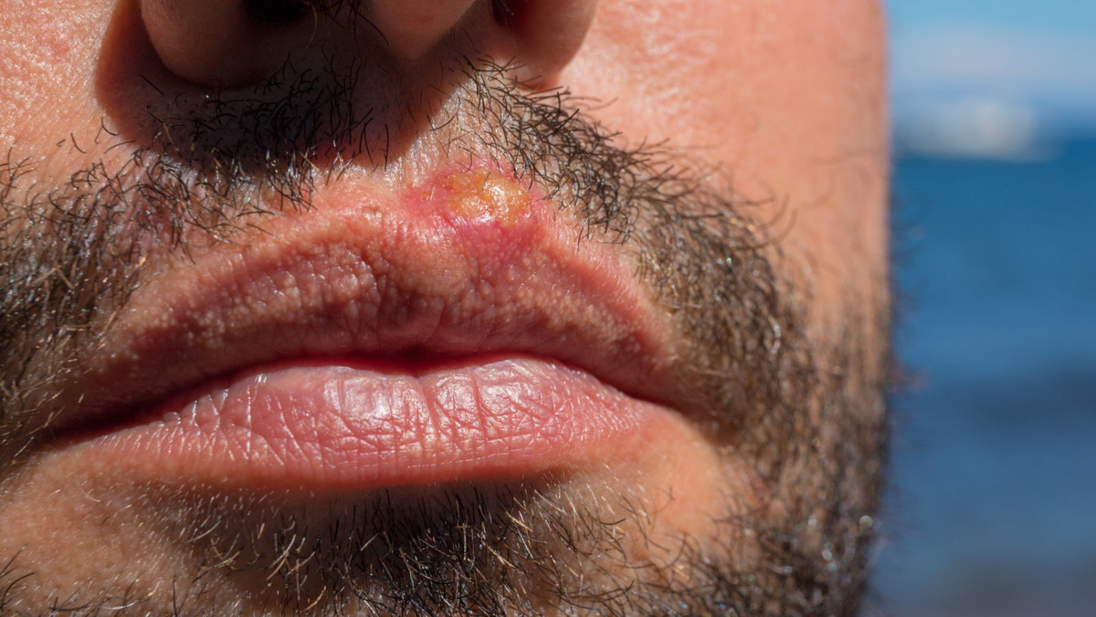 Sonnen-Herpes: Zwischen Lippenpflege & LSF | APOTHEKE ADHOC