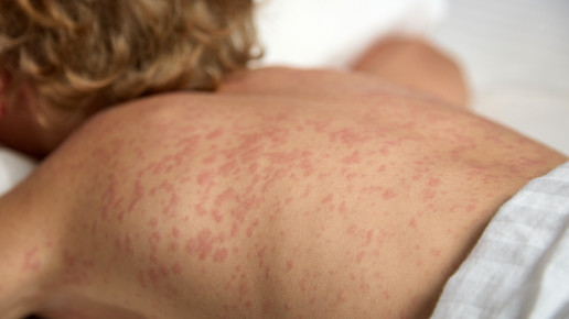 Ringelröteln: Überwachung für Schwangere