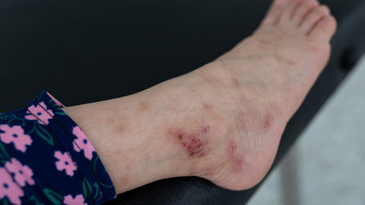 Mückenstiche: Immer häufiger ein Fall für den Arzt