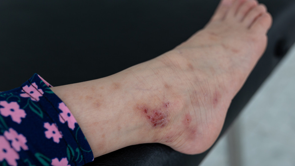 Mückenstiche Immer häufiger ein Fall für den Arzt APOTHEKE ADHOC