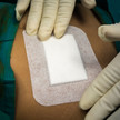 Neuer Silikonverband: Blutstillung ohne Verkleben