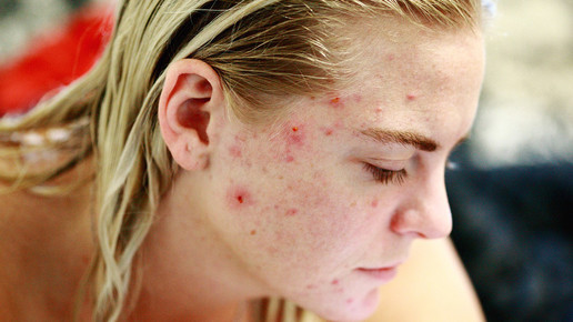 Pubertät und Spätakne: Neuheiten gegen unreine Haut