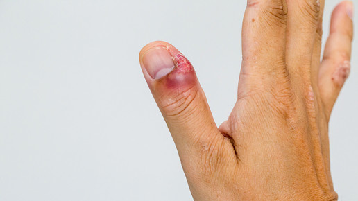 Foto: Eine Nagelbettentzündung am Daumen der rechten Hand.