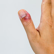 Foto: Eine Nagelbettentzündung am Daumen der rechten Hand.