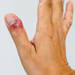 Foto: Eine Nagelbettentzündung am Daumen der rechten Hand.