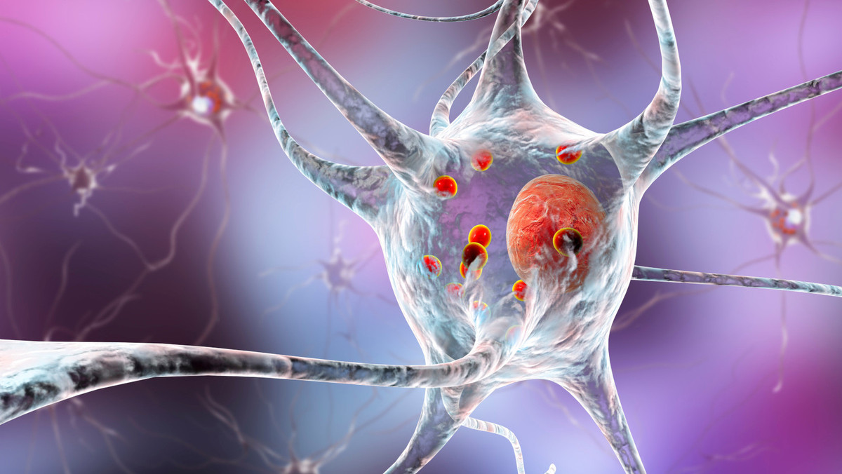 Parkinson: Proteinablagerungen als Therapieansatz?