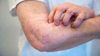 Neurodermitis: Studie prüft Therapie im 12-Wochen-Rhythmus