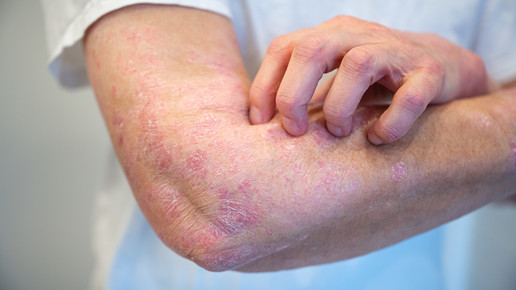 Foto: Eine Person hat gerötete, schuppende Stellen am Arm.