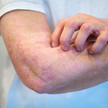 Foto: Eine Person hat gerötete, schuppende Stellen am Arm.