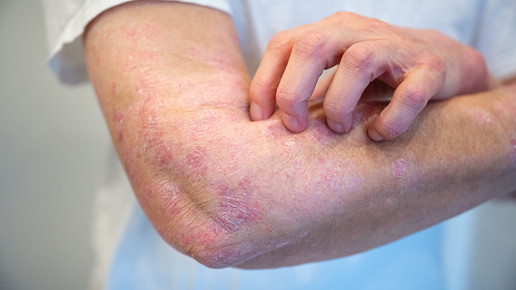 Neurodermitis: Studie prüft Therapie im 12-Wochen-Rhythmus